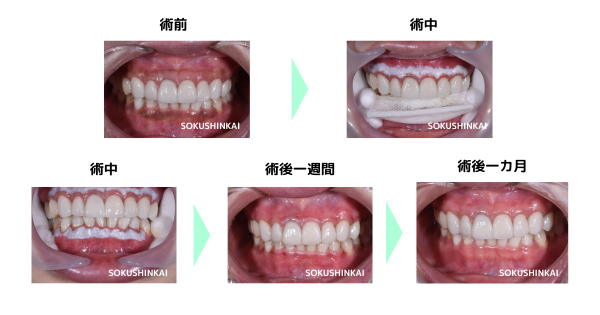 歯茎のホワイトニング　術前と術後の比較